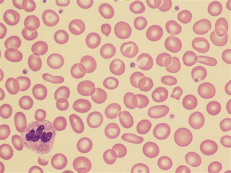 American Journal of Hematology | Blood Research Journal | Wiley Online ...