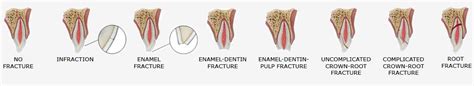 Luxation injury: Extrusion – Dental Trauma Guide