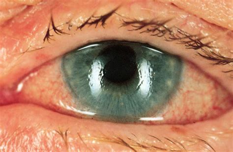 Study Medical Photos: Acute Angle-Closure Glaucoma