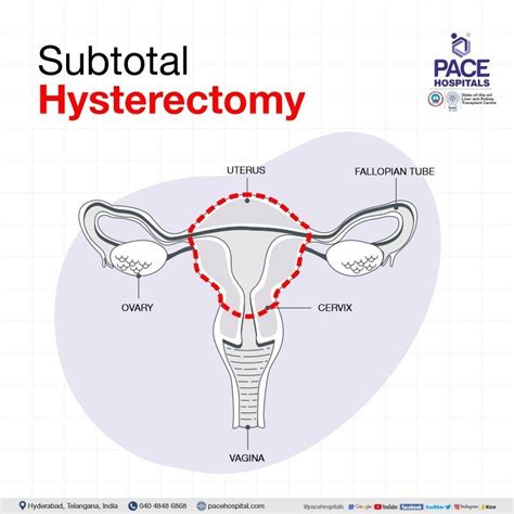 Hysterectomy Surgery in Hyderabad - Indications, Side effects & Cost