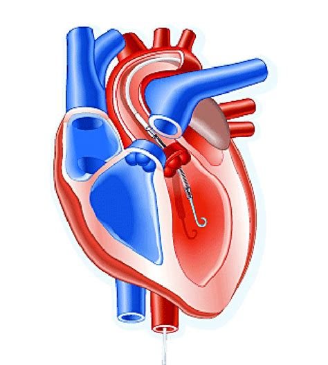 Impella heart pump may enable 30-minute reperfusion delay | MDedge ...