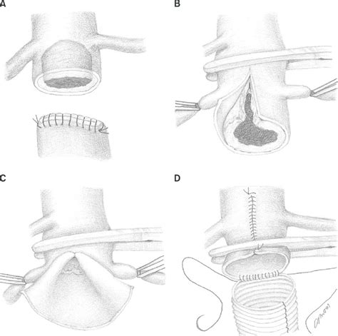 Schematic drawing of the surgical reconstruction of the juxtarenal... | Download Scientific Diagram