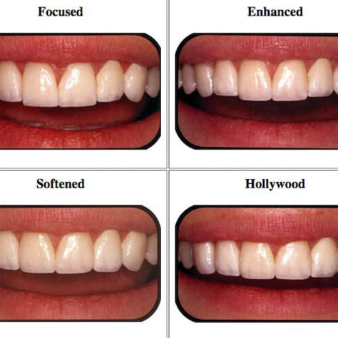 How to Choose the Best Veneers for Your Face Shape | Dr. Raanan