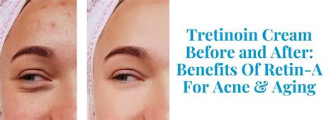 Tretinoin Before & After: Benefits Of Retin-A- Pandia Health