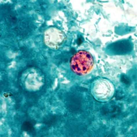 At least 1 local case of Cyclospora connected to national outbreak | CTV News