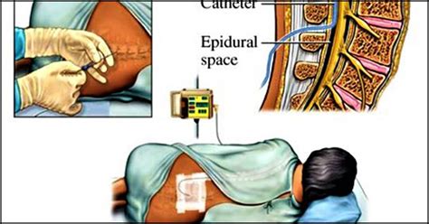 Epidural Analgesia For Labor: What It Is And Side Effects