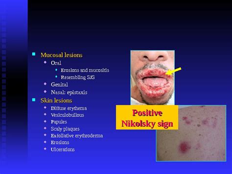 Mucocutaneous Diseases Azmi Darwazeh BDS.