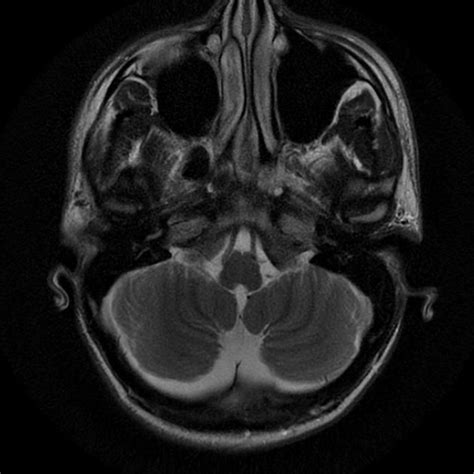 Mega cisterna magna | Radiology Case | Radiopaedia.org Magna, Radiology, Skull, Case, Skulls ...