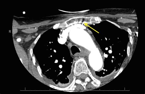 Sternal Fracture | Emory School of Medicine