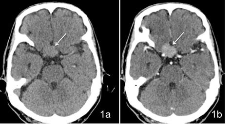 Suprasellar meningioma – Radiology Cases