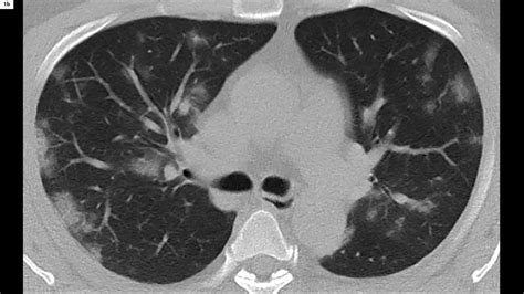 COVID-19 Pneumonia