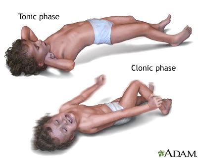 Grand mal seizure: MedlinePlus Medical Encyclopedia Image