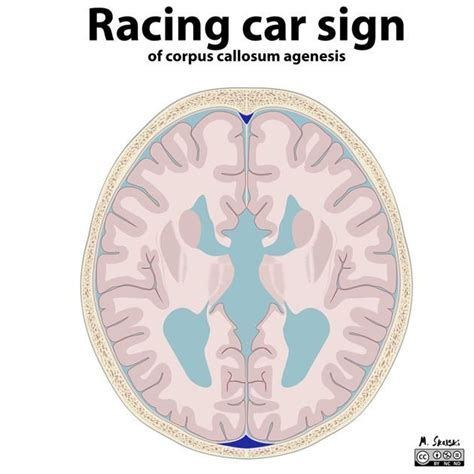 Corpus callosum agenesis illustrations | Radiology Case | Radiopaedia.org | Corpus callosum ...