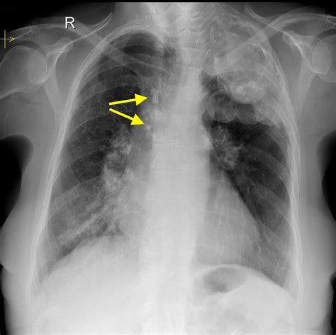 Plombage - Radiology at St. Vincent's University Hospital