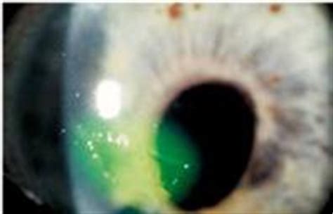 Symptoms of recurrent corneal erosion | Eye Disorders and Diseases articles | Body & Health ...