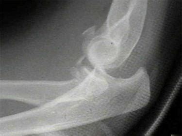 Terrible Triad Injury of Elbow - Trauma - Orthobullets