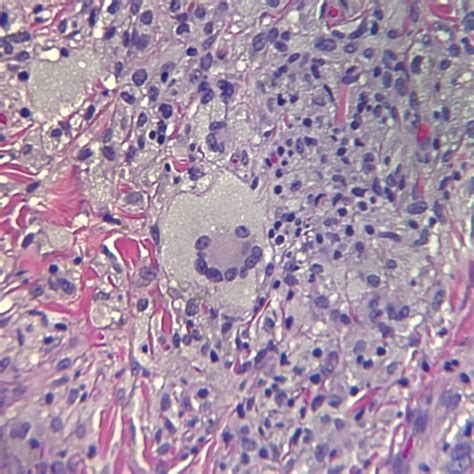 [Figure, Classic multinucleated (Touton) giant cell...] - StatPearls - NCBI Bookshelf