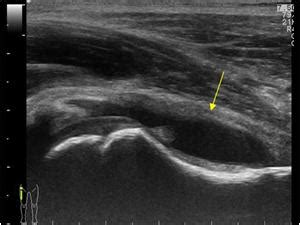 Pediatrics | 9.7 Infant hip and knee : Case 9.7.7 Coxitis and hydrops ...