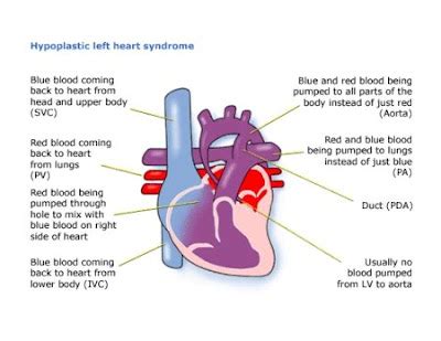 Life As A Pediatric Nurse: Hypoplastic Left Heart Syndrome (HLHS)