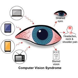 Computer vision syndrome - Anmol Eye Clinic