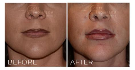 Lip Lift Recovery | Utah Facial Plastics | Layton & Draper, Ut