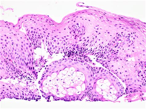 Mucoepidermoid Carcinoma Histology