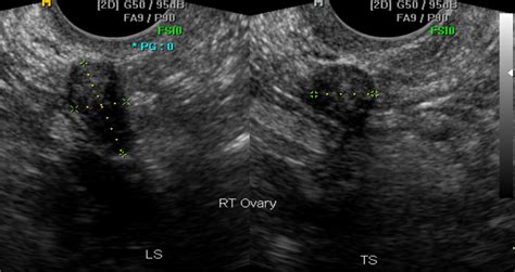 Ovarian Cancer Normal Pelvic Ultrasound Images - Follicle Detection And Ovarian Classification ...