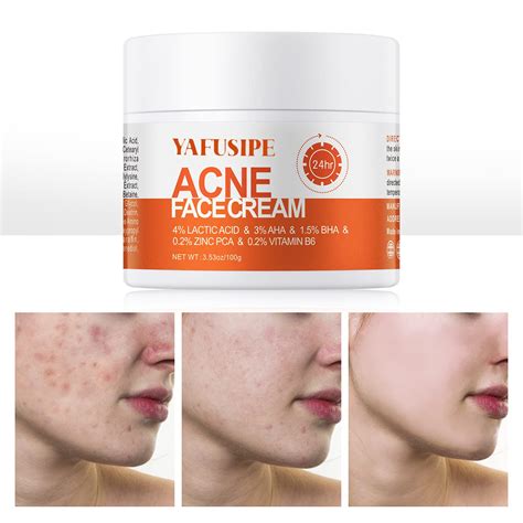 Acne Treatment