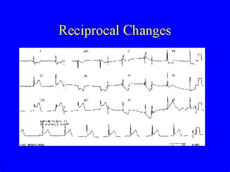 An Introduction to the 12 lead ECG Dr