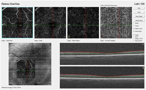 OCT Angiography – Visual Surgery