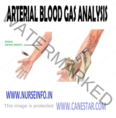 ARTERIAL BLOOD GAS ANALYSIS - Nurse Info