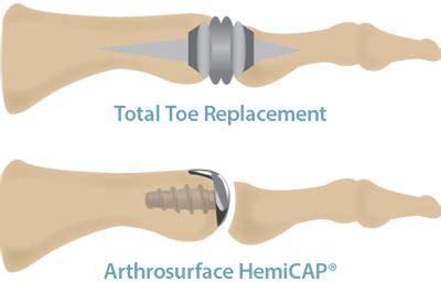 Foot and Ankle Conditions | Hemicap MTP