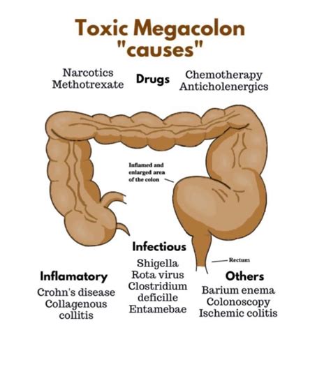 Toxic Megacolon Causes - MEDizzy