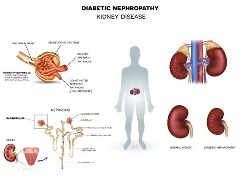 Diabetic Nephropathy, kidney disease poster #poster, #printmeposter, #mousepad, #tshirt ...