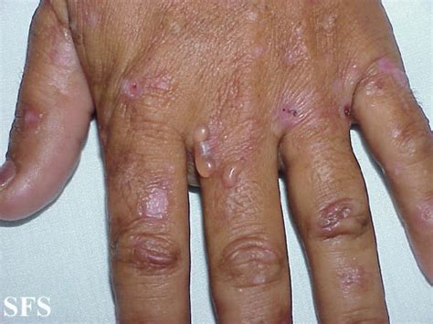 Porphyria cutanea tarda physical examination - wikidoc