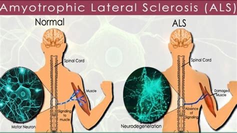 Causes of Lou Gehrig's Disease (ALS)