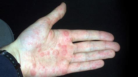 Dyshidrotic Eczema: Overview, Causes, Diagnosis & Pictures