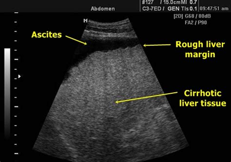 Liver - Sonography | Medicína, nemoci, studium na 1. LF UK