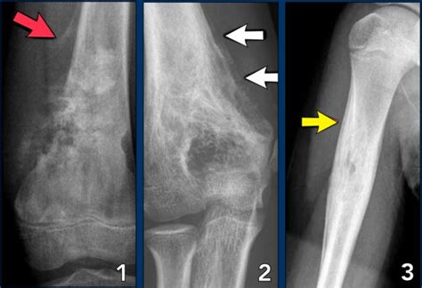 Osteogenic Sarcoma Codmans Triangle