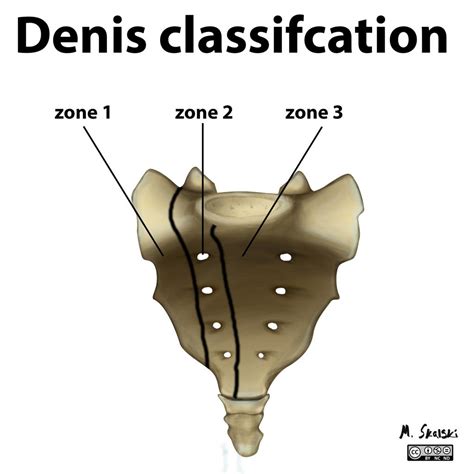 Sacral Fractures - Presentation and Treatment | Bone and Spine