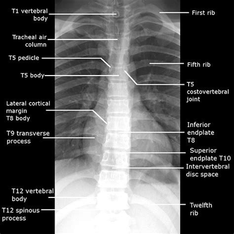 Normal Thoracic X Ray