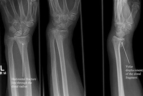 Barton's fracture | hand (or distal joint) articulated to distal portion of bone which can move ...