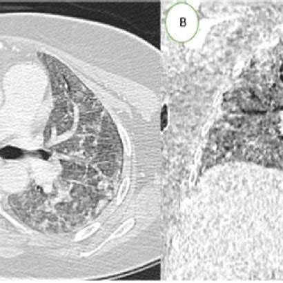 Chest CT scan in axial (A) and coronal (B) lung parenchyma windows ...