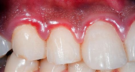 Gingivitis: Should I Be Worried About Bleeding Gums?