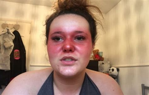 Teenager with lupus rash on her face shows off her 90 minute beauty ...