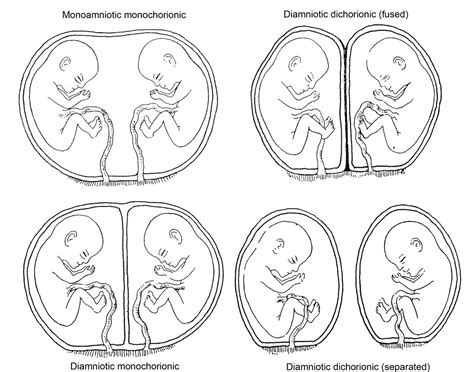 mono+mono+twin+ultrasounds | ... Monozygotic, Dizygotic, Monochorionic, Monoamniotic, Mono-Mono ...