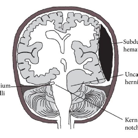 CT of the head showing gross posterior and lateral displacement of... | Download Scientific Diagram