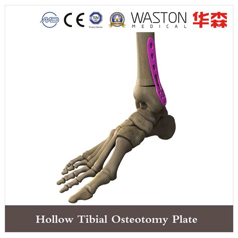 Surgical Instrument Hollow Tibial Osteotomy Plate - China Ankle Product ...