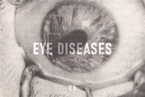 Eye Diseases — 60+ Scanned Images