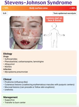 emDOCs.net – Emergency Medicine EducationEM@3AM: Stevens-Johnson Syndrome and Toxic Epidermal ...